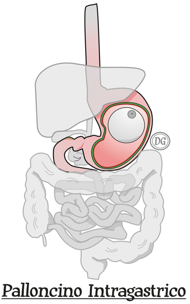Palloncino Intragastrico