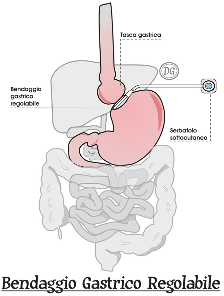 Bendaggio gastrico