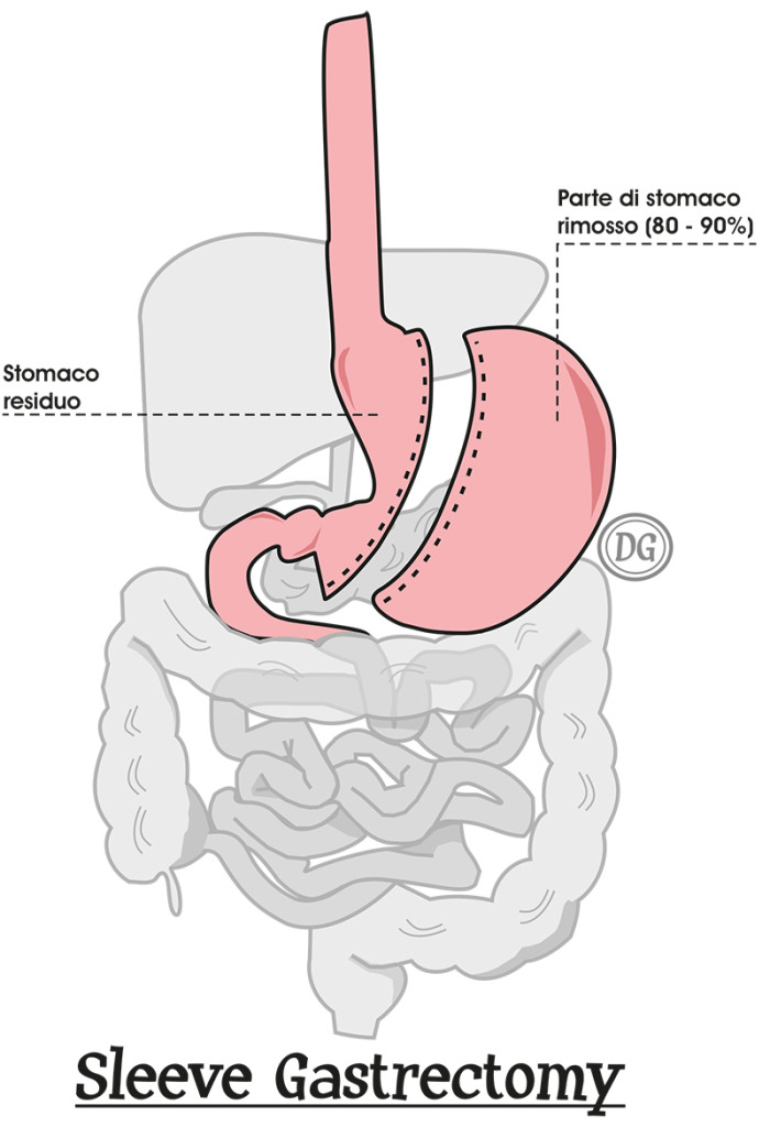 Sleeve Gastrectomy