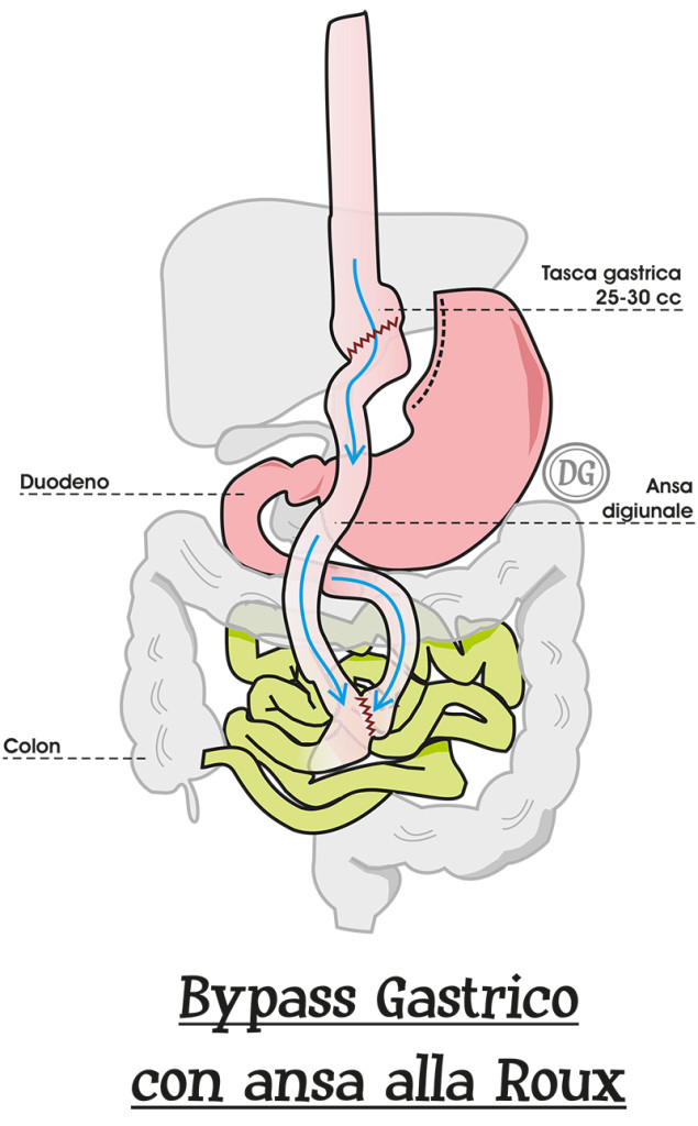 Bypass Gastrico