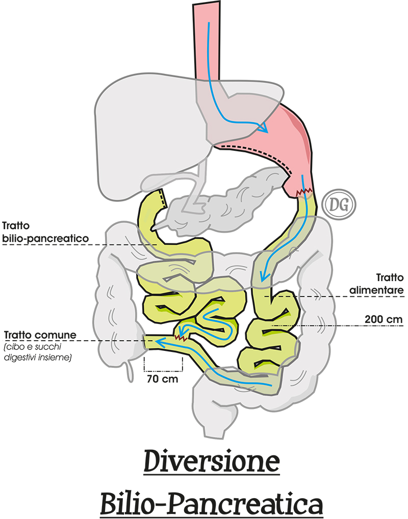 Diversione biliopancreatica (DBP)